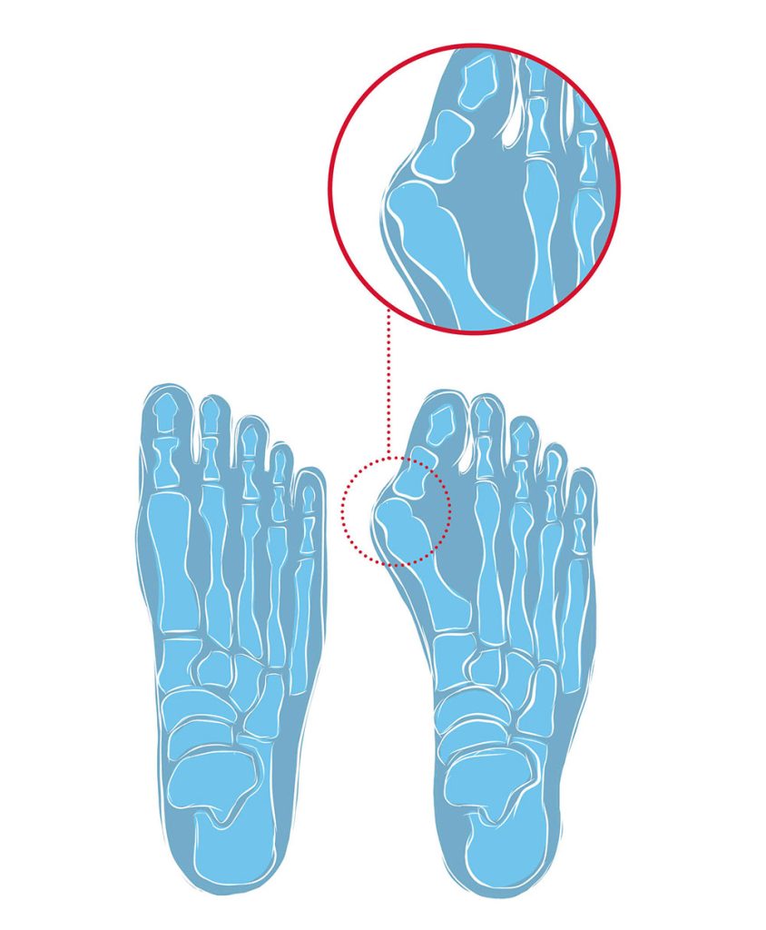 Hanwag Klarsby Bunion schoenen: de oplossing voor wandelaars met Hallux Valgus